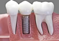 dental implant