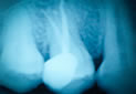 root canal treatment